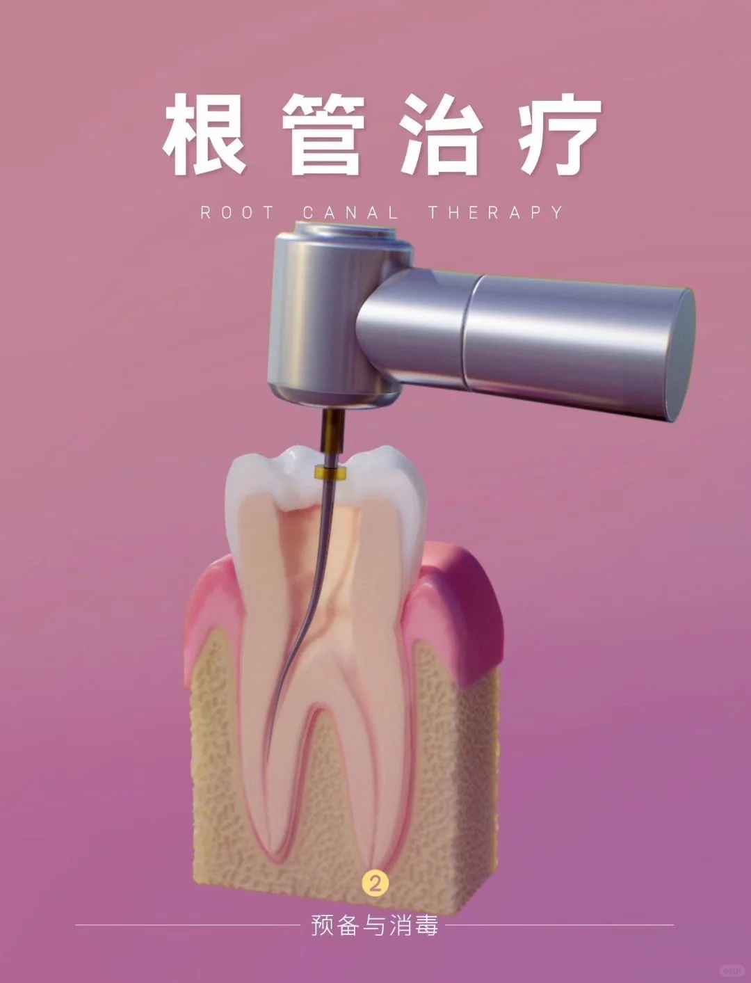 你知道根管主要是什么样的吗