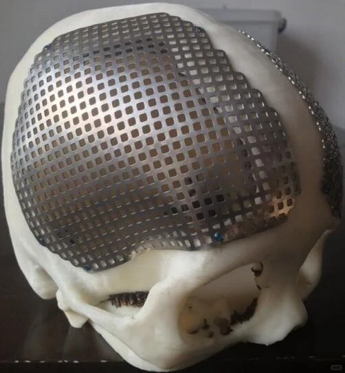 头盖骨成形材料：PEEK聚醚醚酮VS钛合金材料