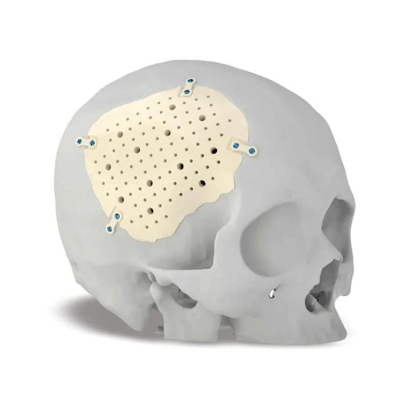 颅骨修补|医生告诉你PEEK的适应症与禁忌症