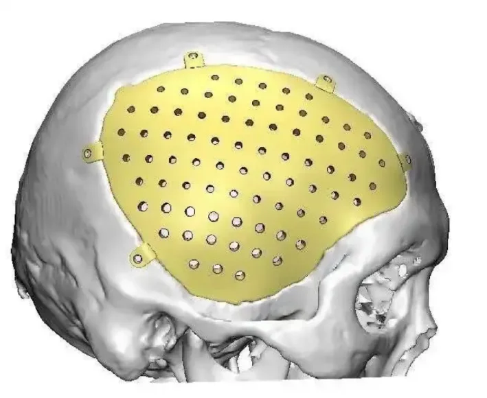 PEEK颅骨修补帮助高空坠落患者成功修复颅骨