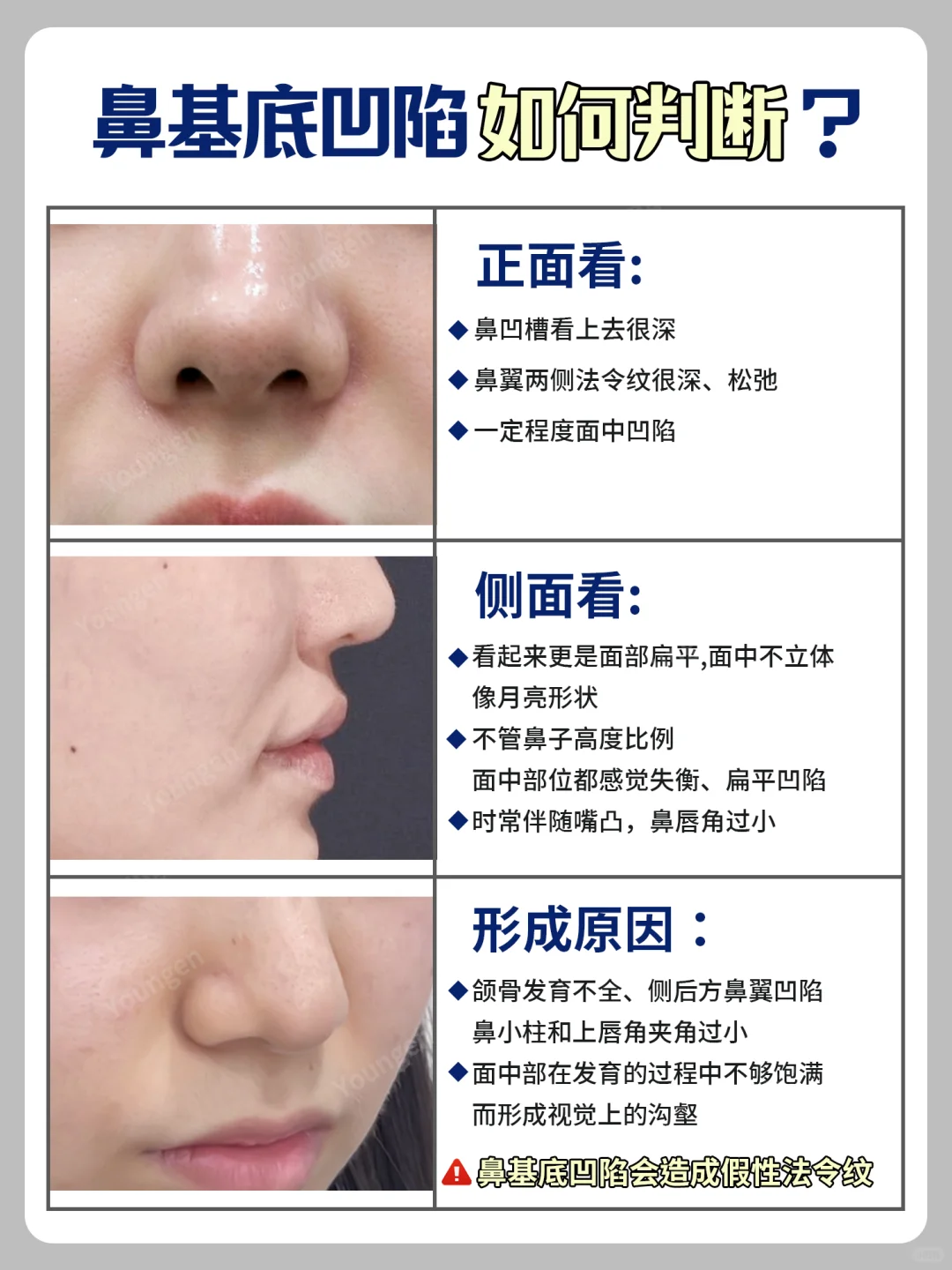 鼻基底凹陷丨面中凹陷如何解决❓