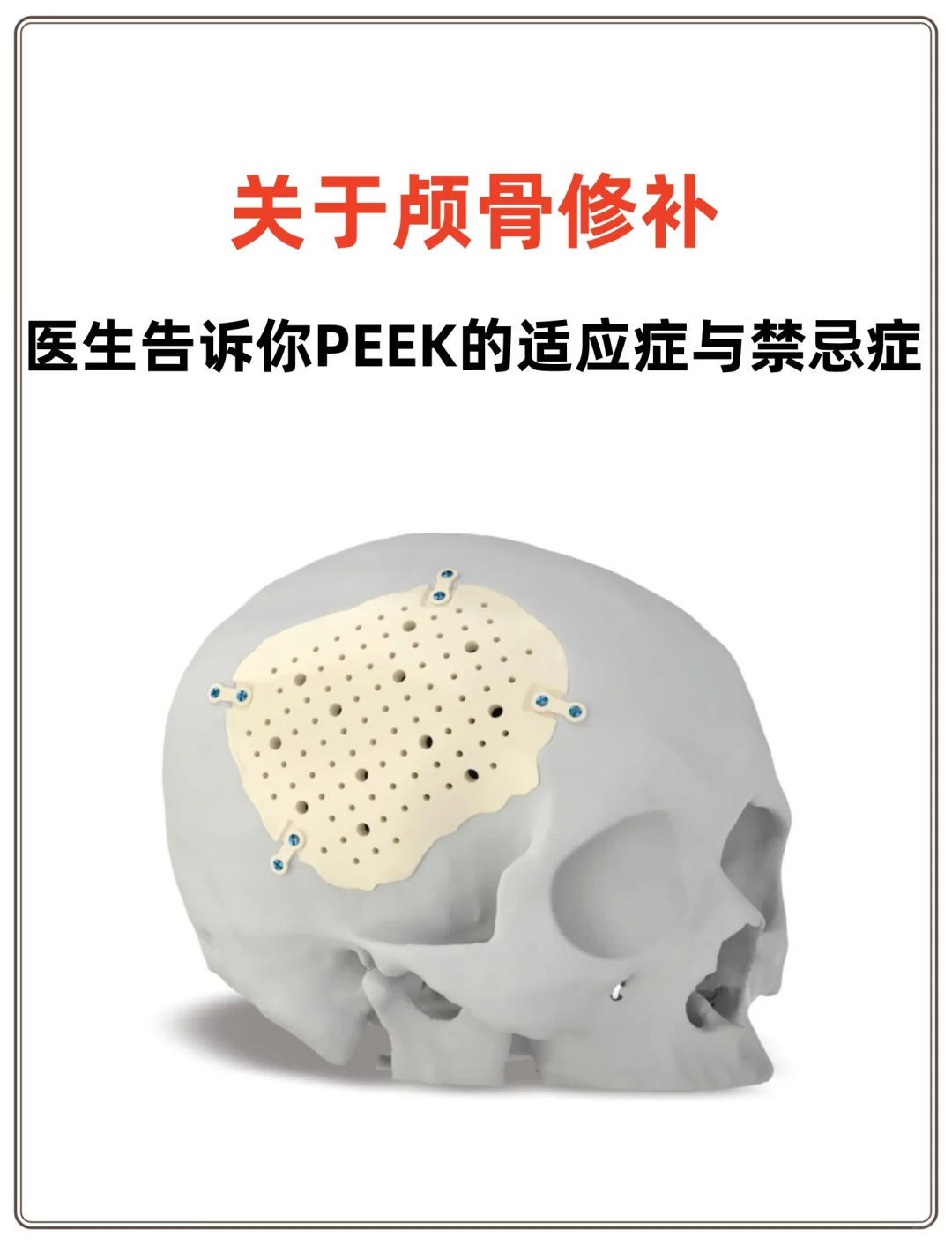颅骨修补|医生告诉你PEEK的适应症与禁忌症