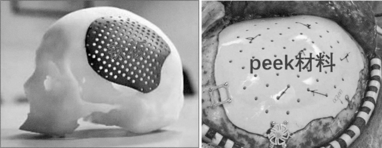 【颅骨修补到底用哪种材料好？】