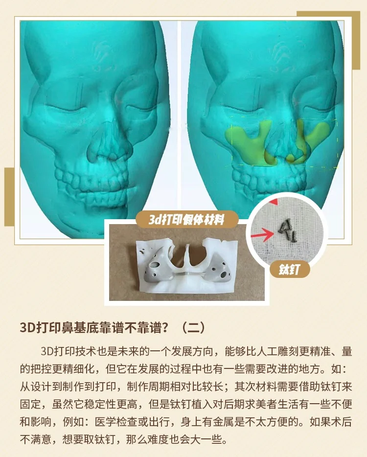 3D打印鼻基底