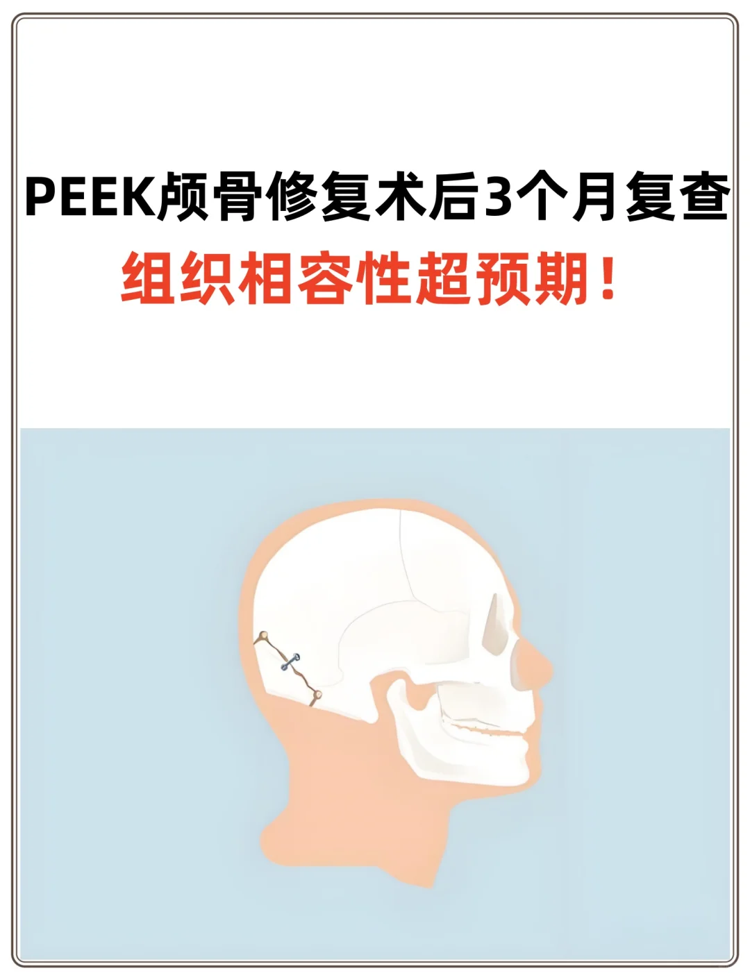 PEEK颅骨修补术后复查，组织相容性超预期！