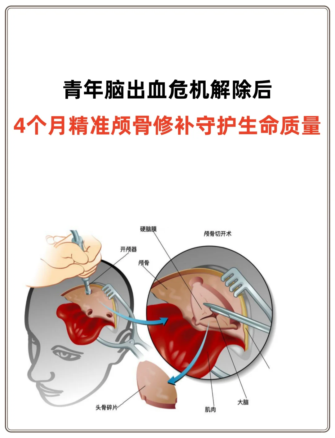 青年脑出血危机解除后，4个月进行颅骨修补