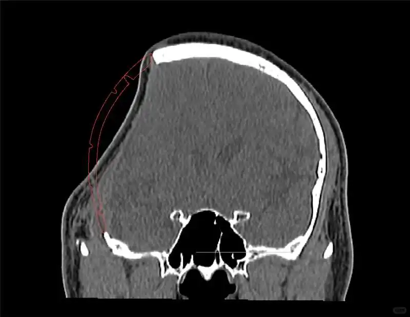 PEEK颅骨修补的术后护理有哪些