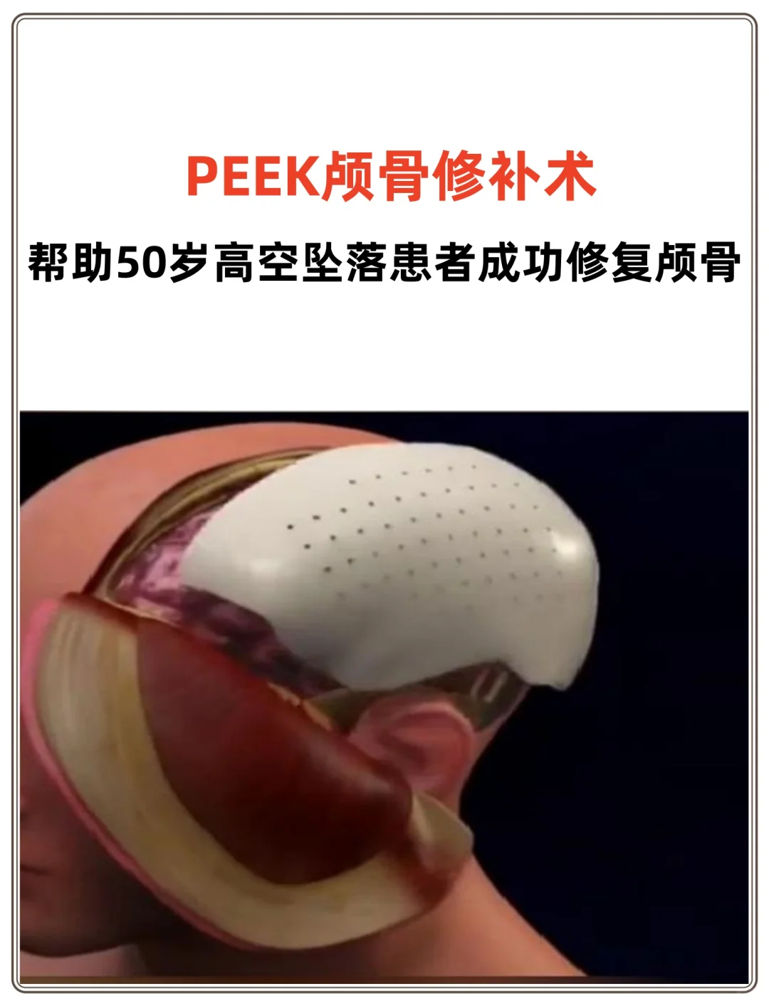 PEEK颅骨修补帮助高空坠落患者成功修复颅骨