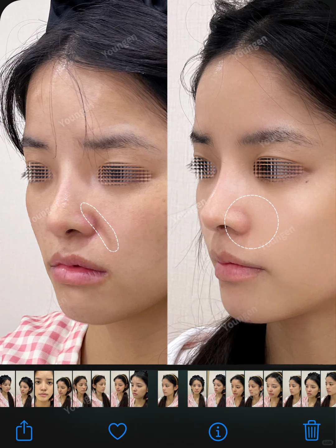 鼻基底凹陷丨面中凹陷如何解决❓