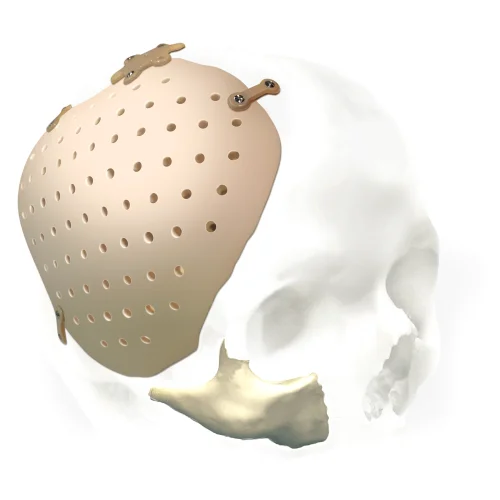 青年脑出血危机解除后，4个月进行颅骨修补