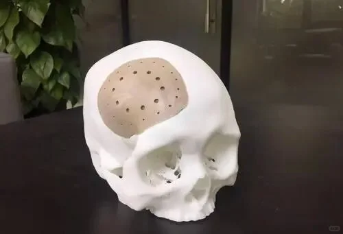 头盖骨成形材料：PEEK聚醚醚酮VS钛合金材料