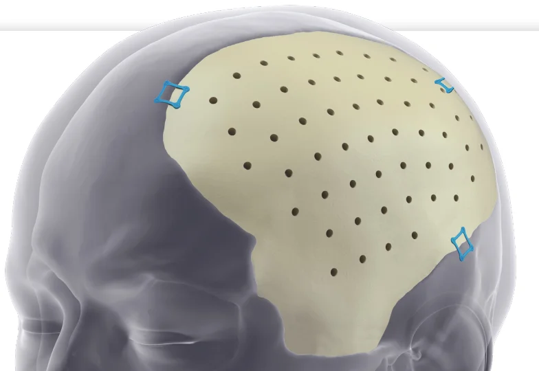 3D打印,严丝合缝!PEEK颅骨修补引领新时代