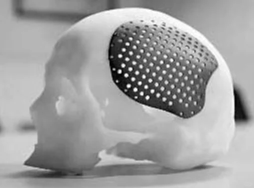 做颅骨修补要花多少钱？通常住几天院？