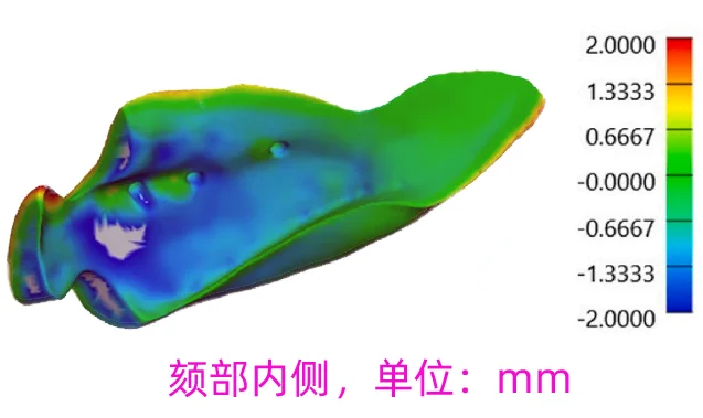 PEEK下巴（颏部）假体成形定位到底多准确？