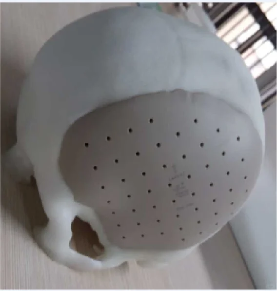 开颅手术及PEEK颅骨修补手术有哪些并发症？