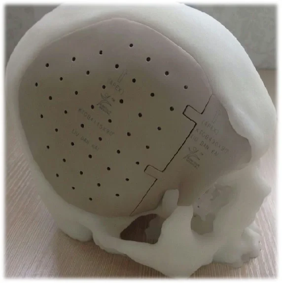 开颅手术及PEEK颅骨修补手术有哪些并发症？