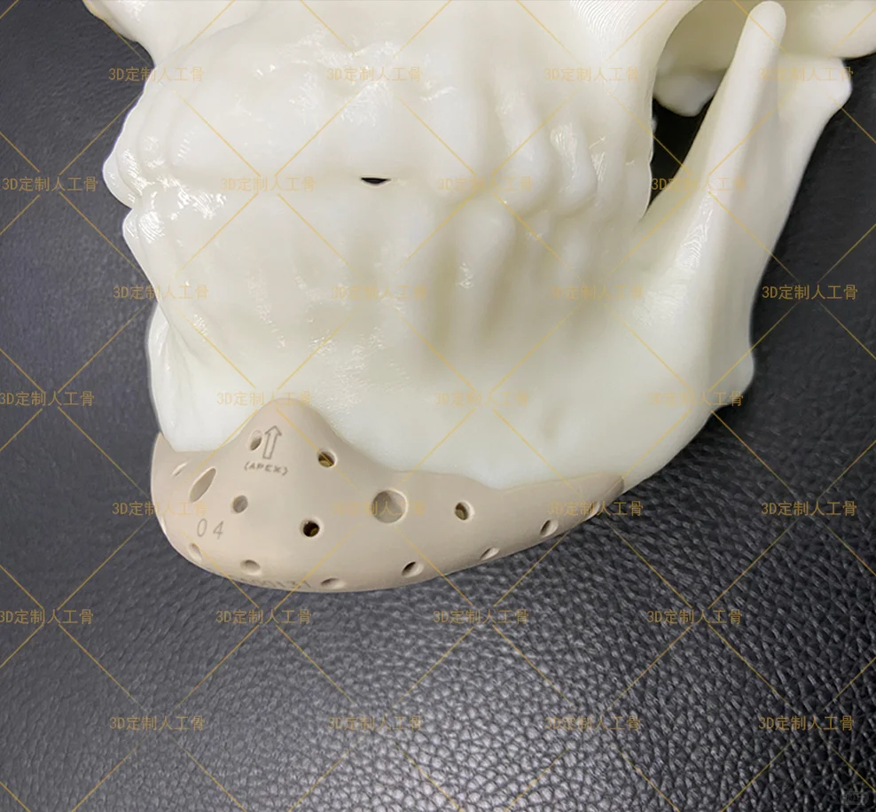 可以定制的假体PEEK！