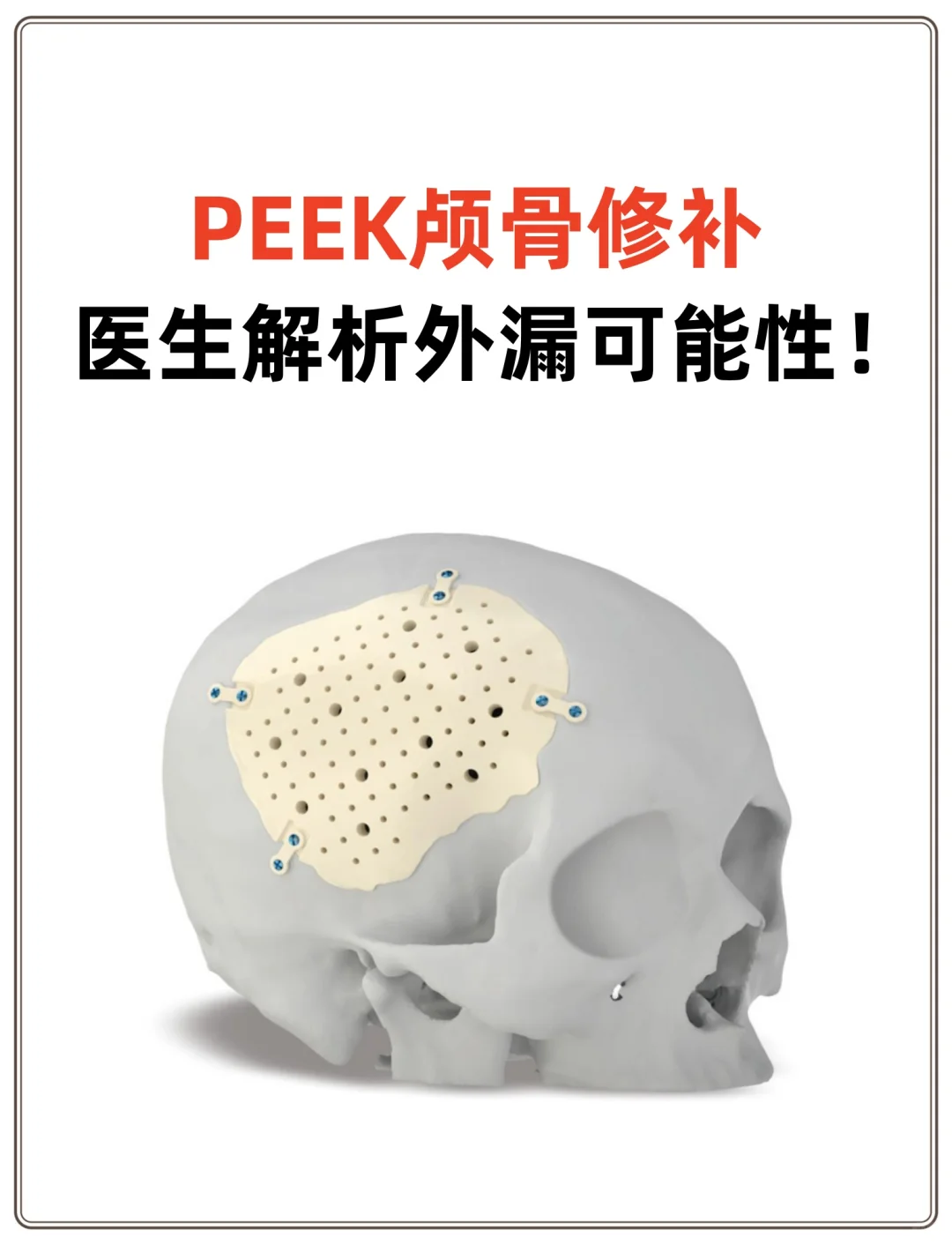 PEEK颅骨修补：医生解析外漏可能性！