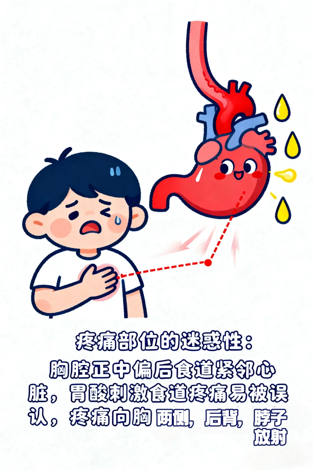 “心脏病”和胃食道反流症状有点像