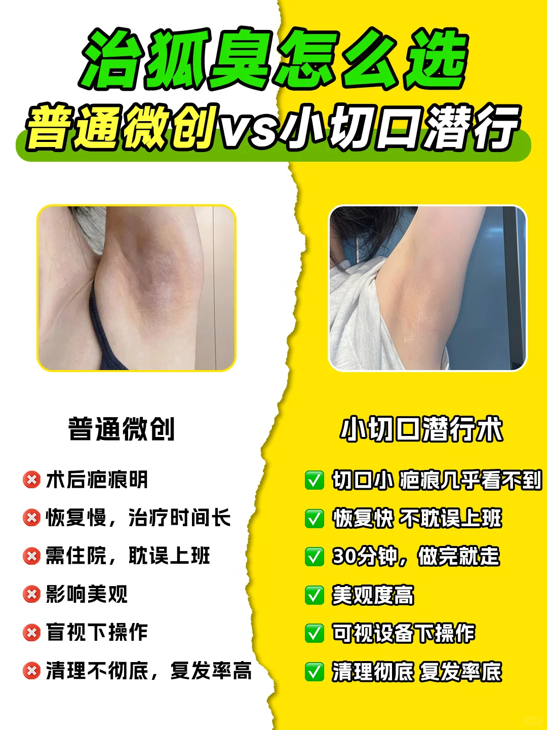 狐臭手术二选一?选择困难症症？不存在！