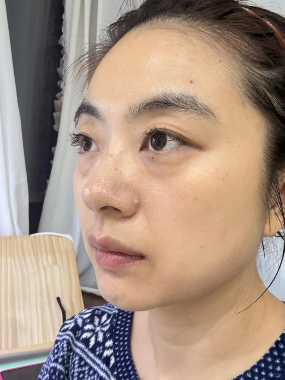 泪沟凹陷打了一支胶原蛋白，效果确实不一样