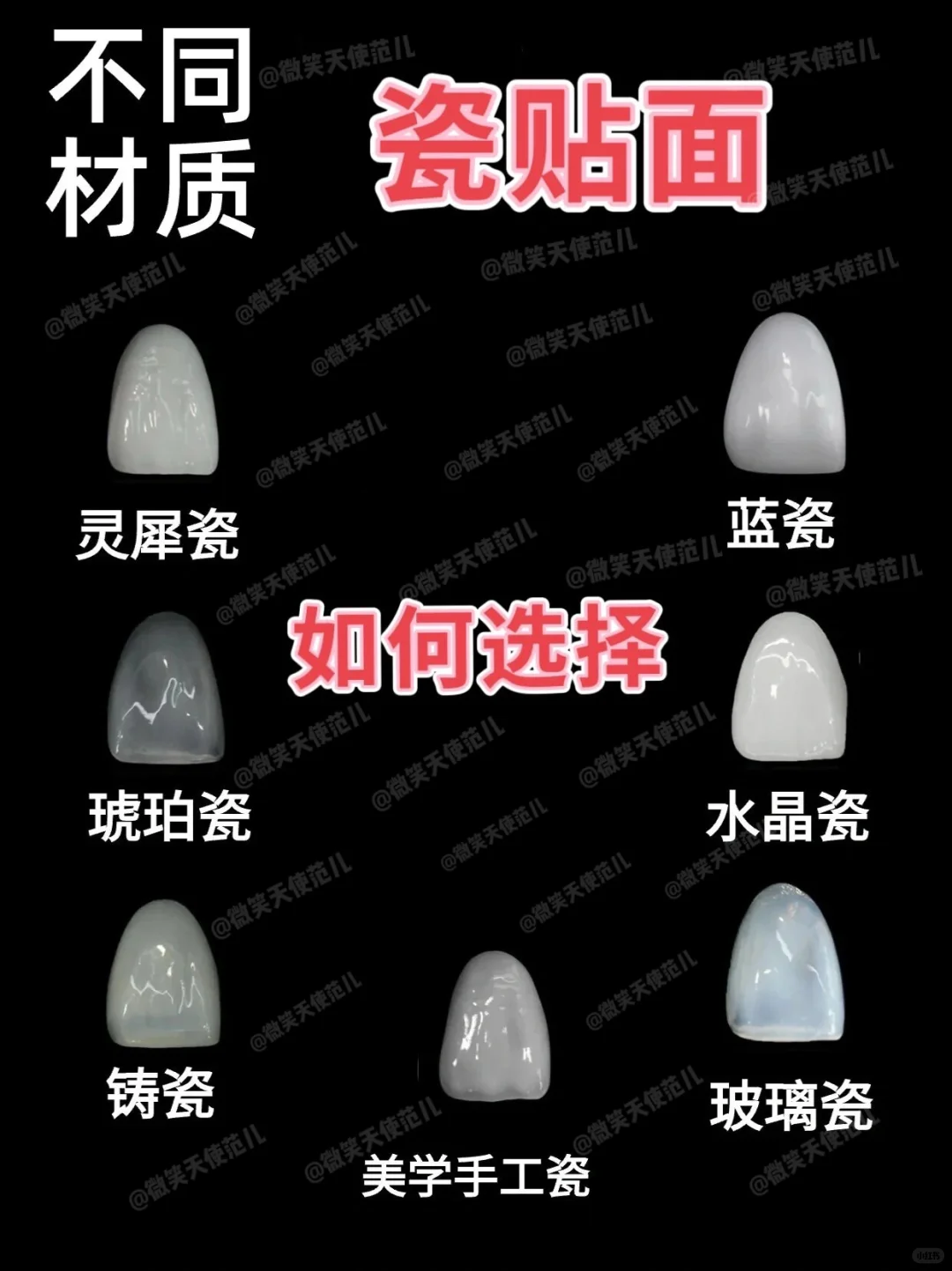 全瓷贴面都是有哪几种?