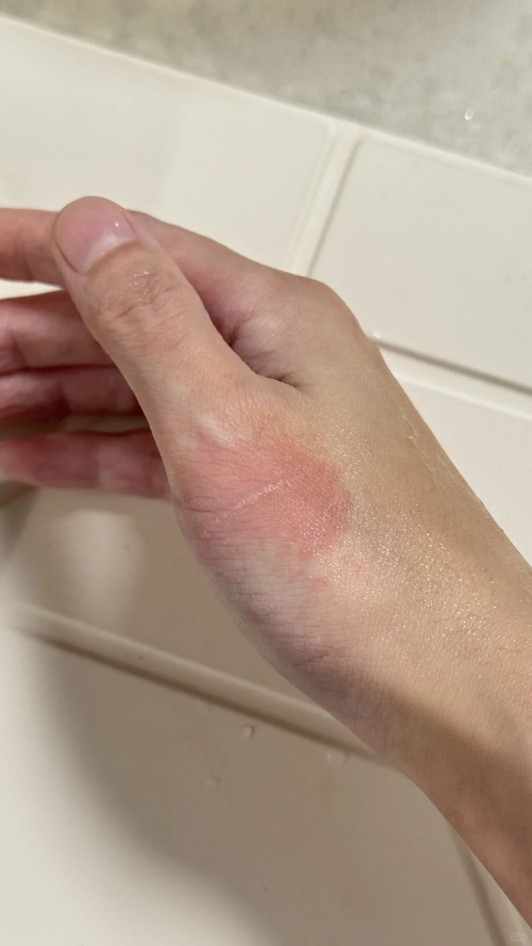 手被不锈钢锅烫伤