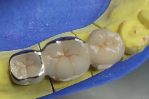 聚合瓷的卓越搭档——二硅酸锂微晶玻璃粉