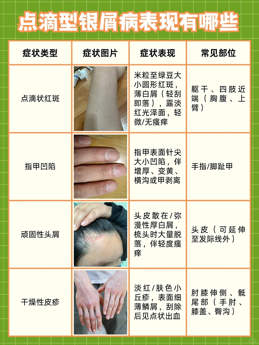 挂青霉素十天银屑病好了，医生解答，速戳！