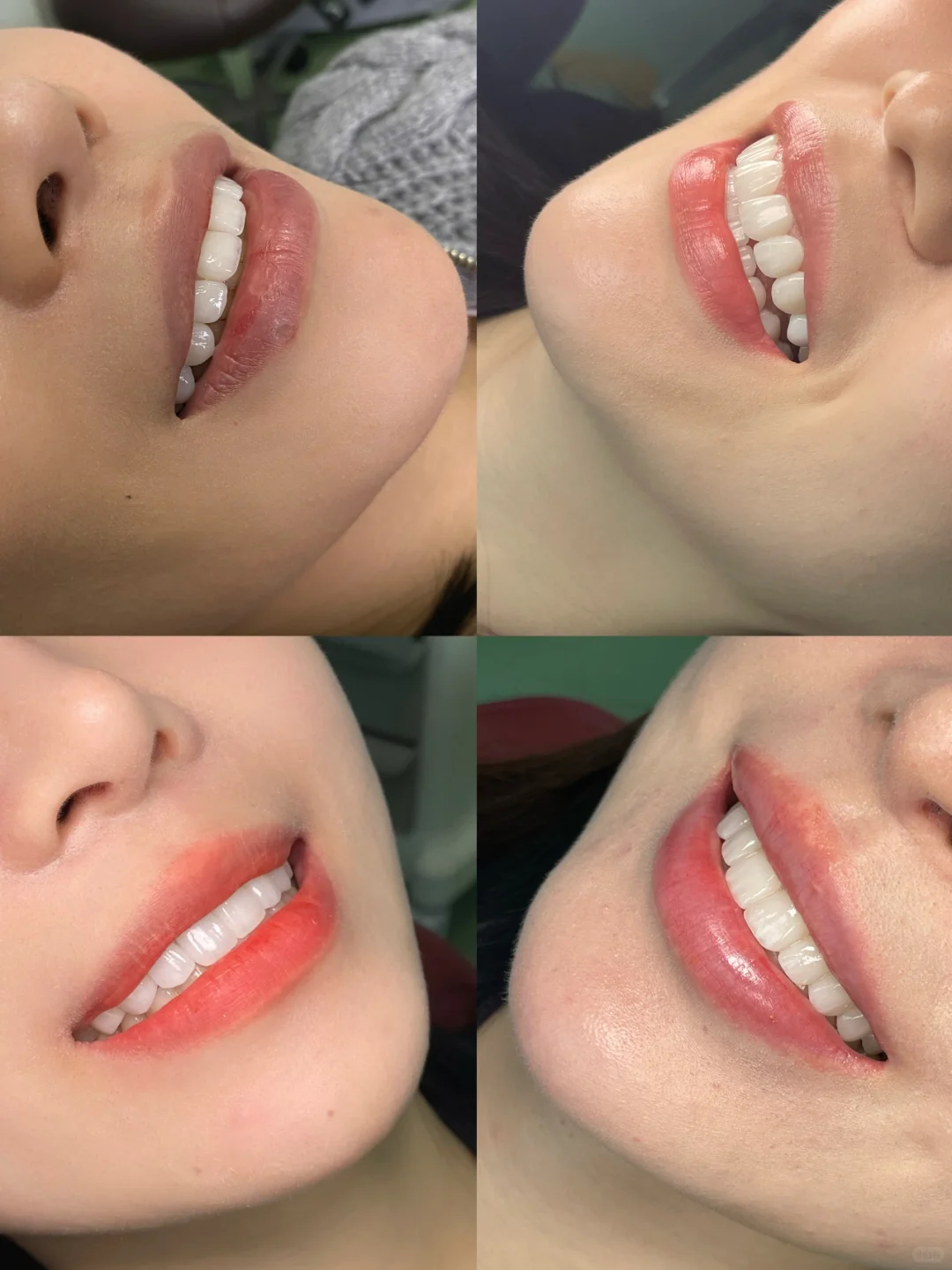 树脂贴面和全瓷贴面的区别在哪❓