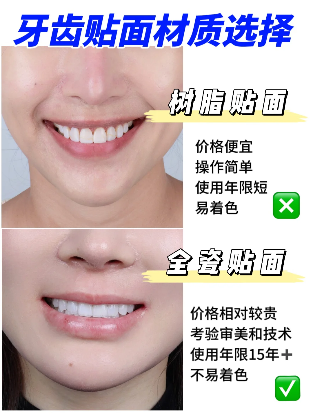 树脂贴面和全瓷贴面的区别在哪❓