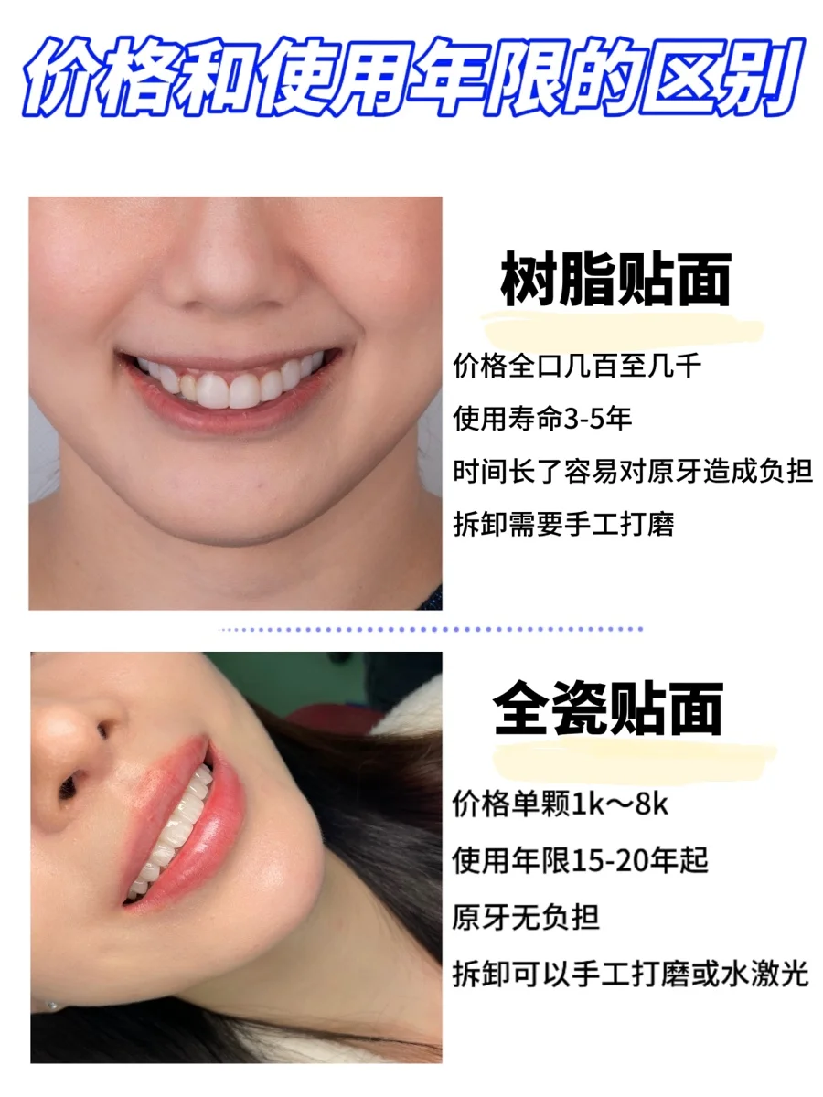 树脂贴面和全瓷贴面的区别在哪❓