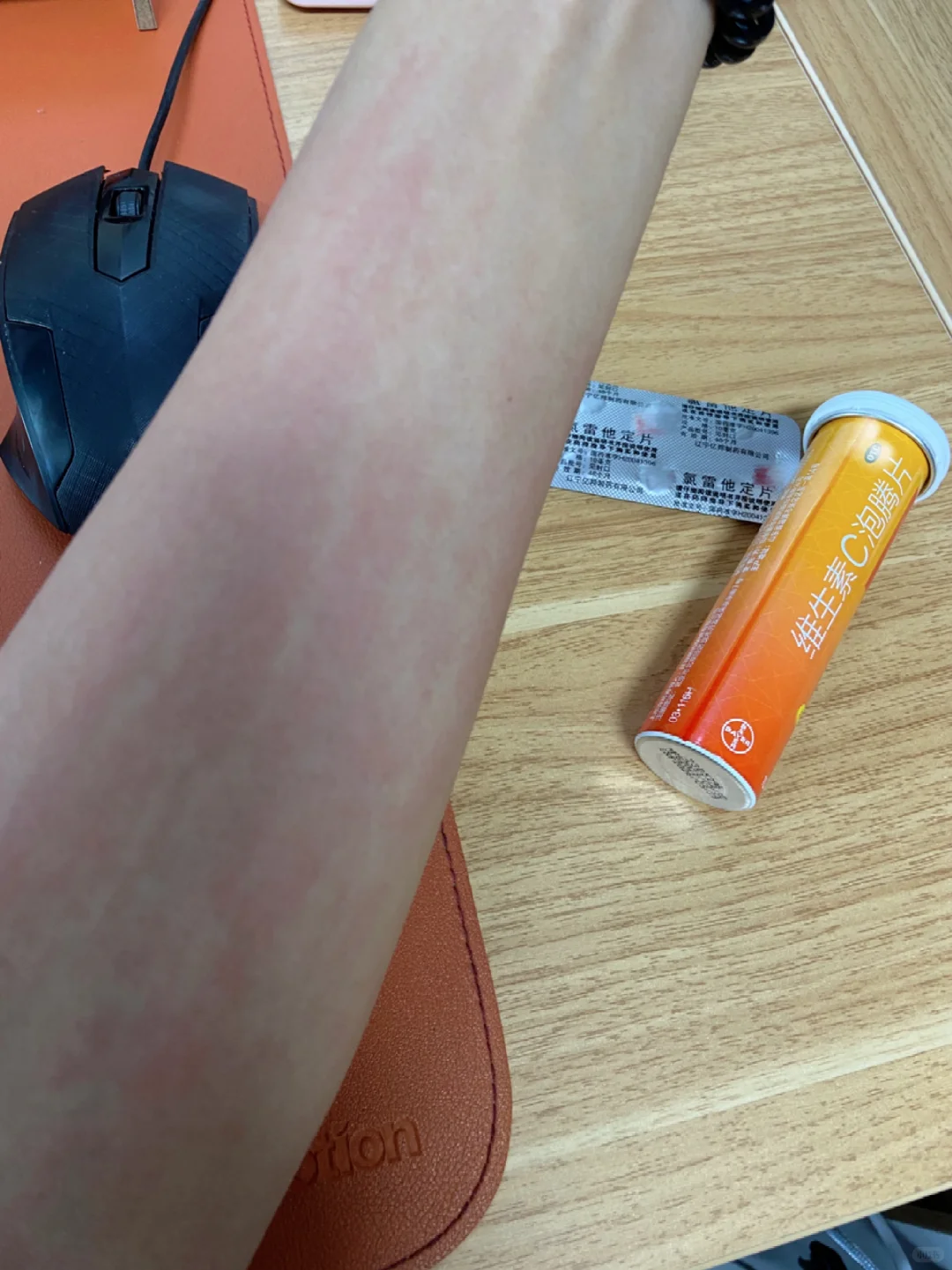 好像过?敏用VC真的?用！