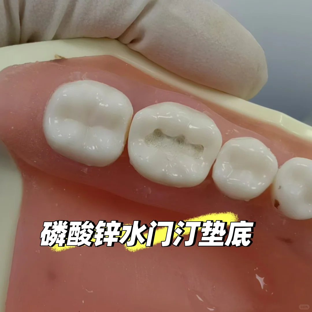 口腔医学实验——窝洞预备与银汞合金充填