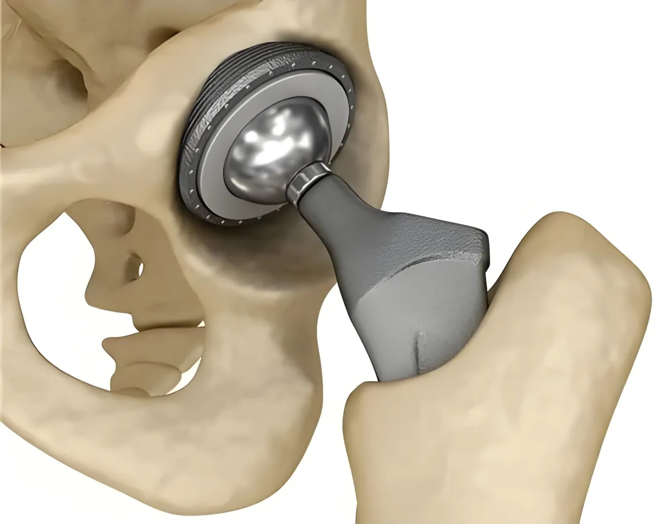 医用钛合金零件加工