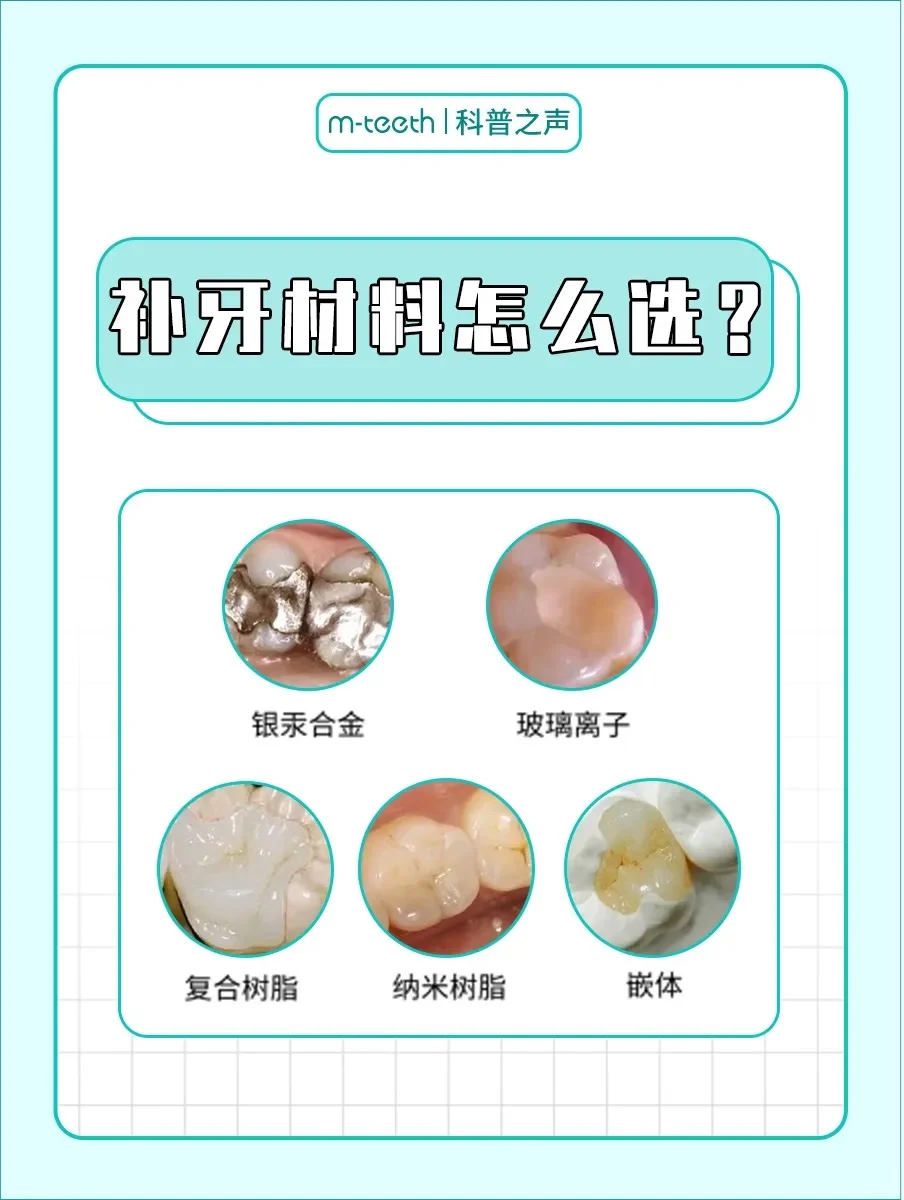 补牙材料怎么选?一篇教你如何选对!