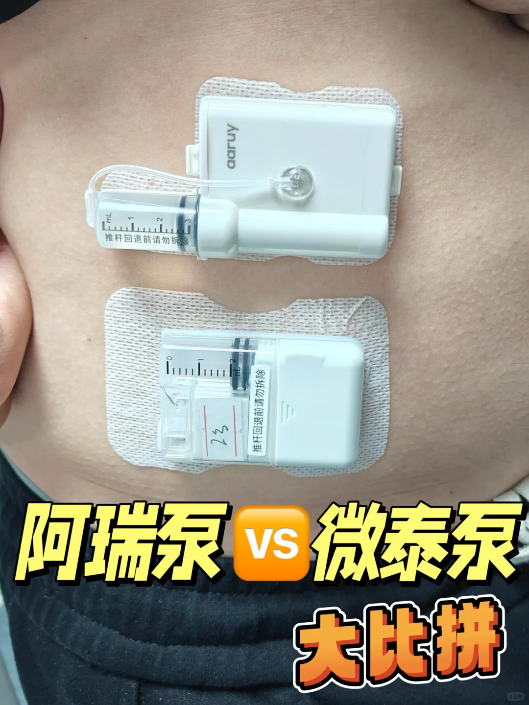 阿瑞泵vs微泰泵:胰岛素泵深度对比