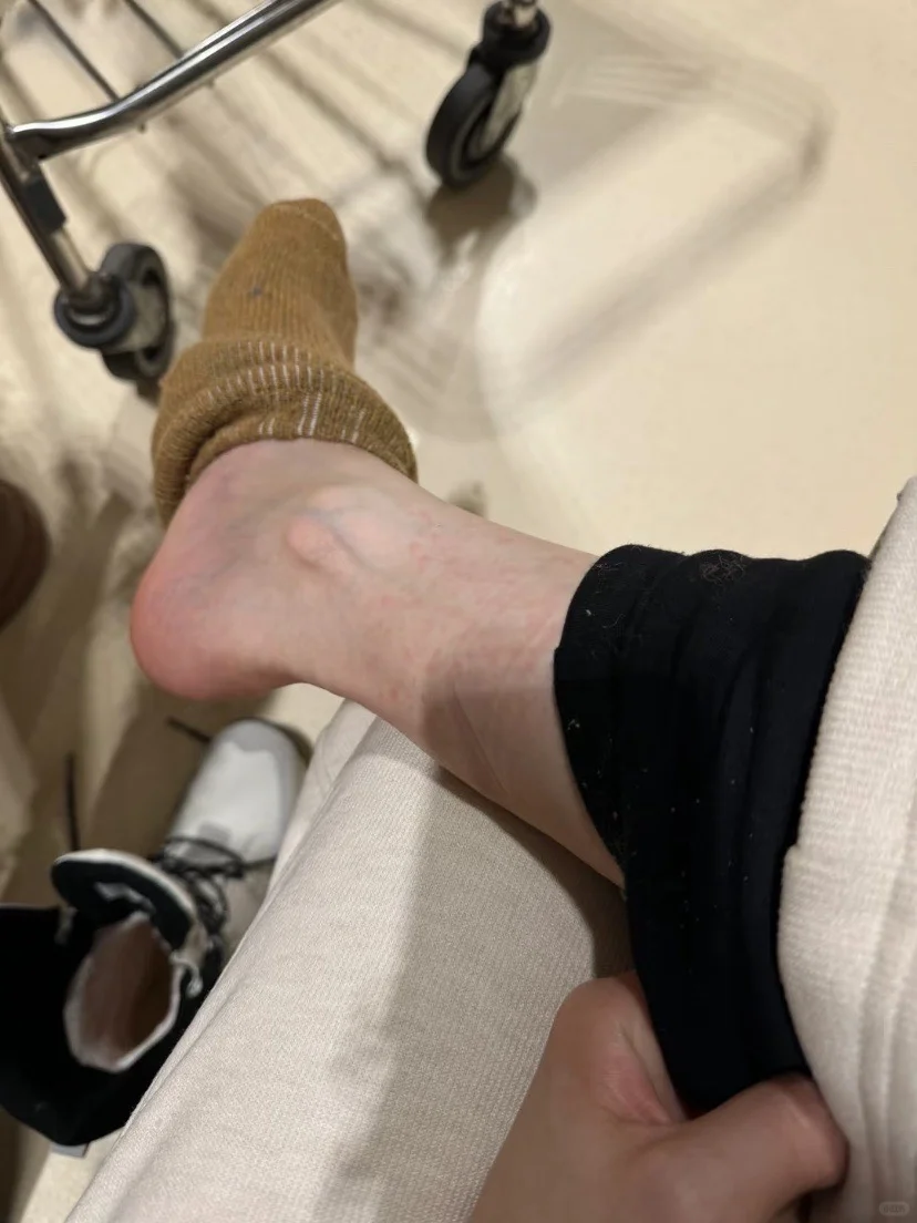 南方土豆在哈尔滨热的捂出了一身痱子?