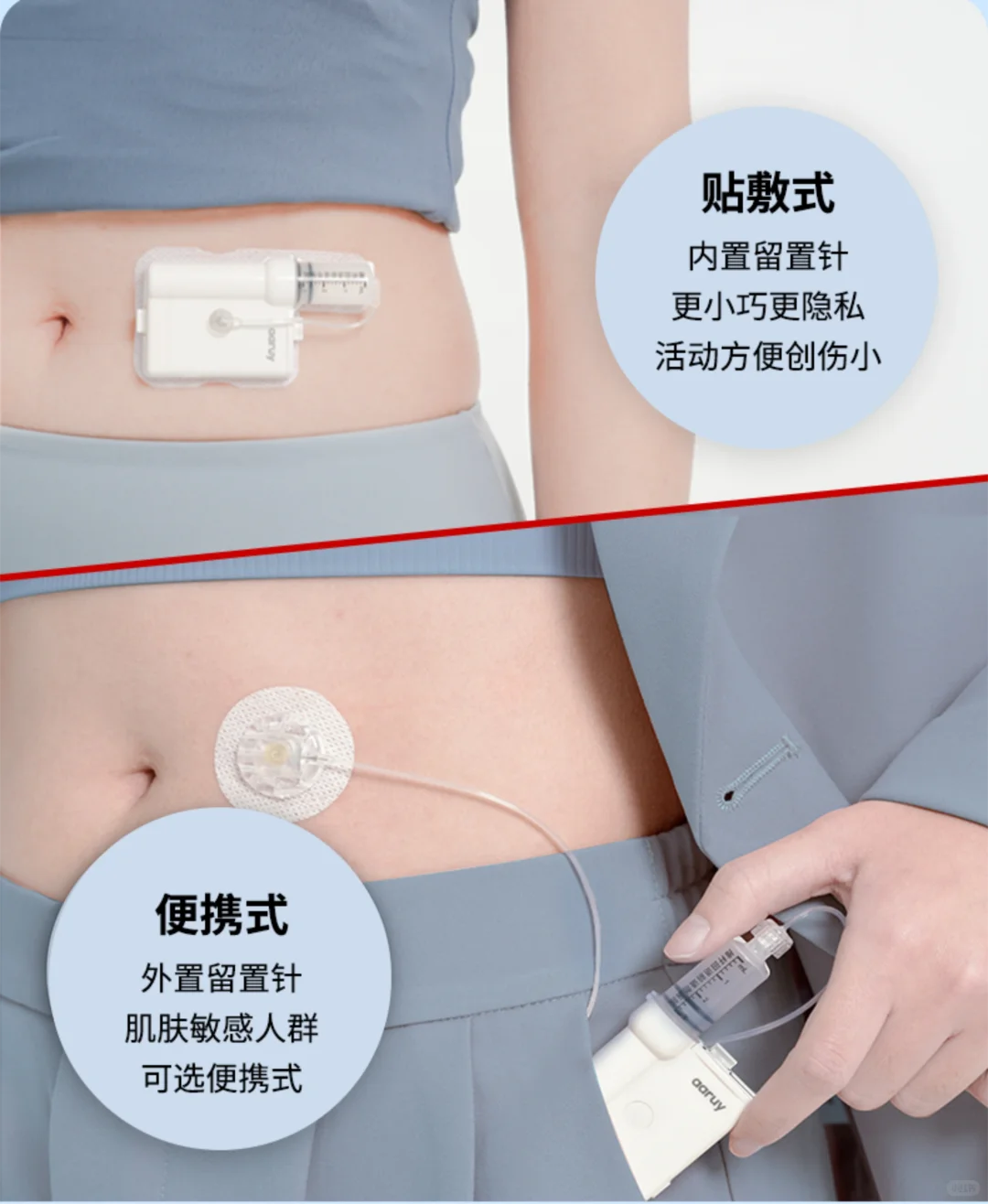 阿瑞泵vs微泰泵:胰岛素泵深度对比