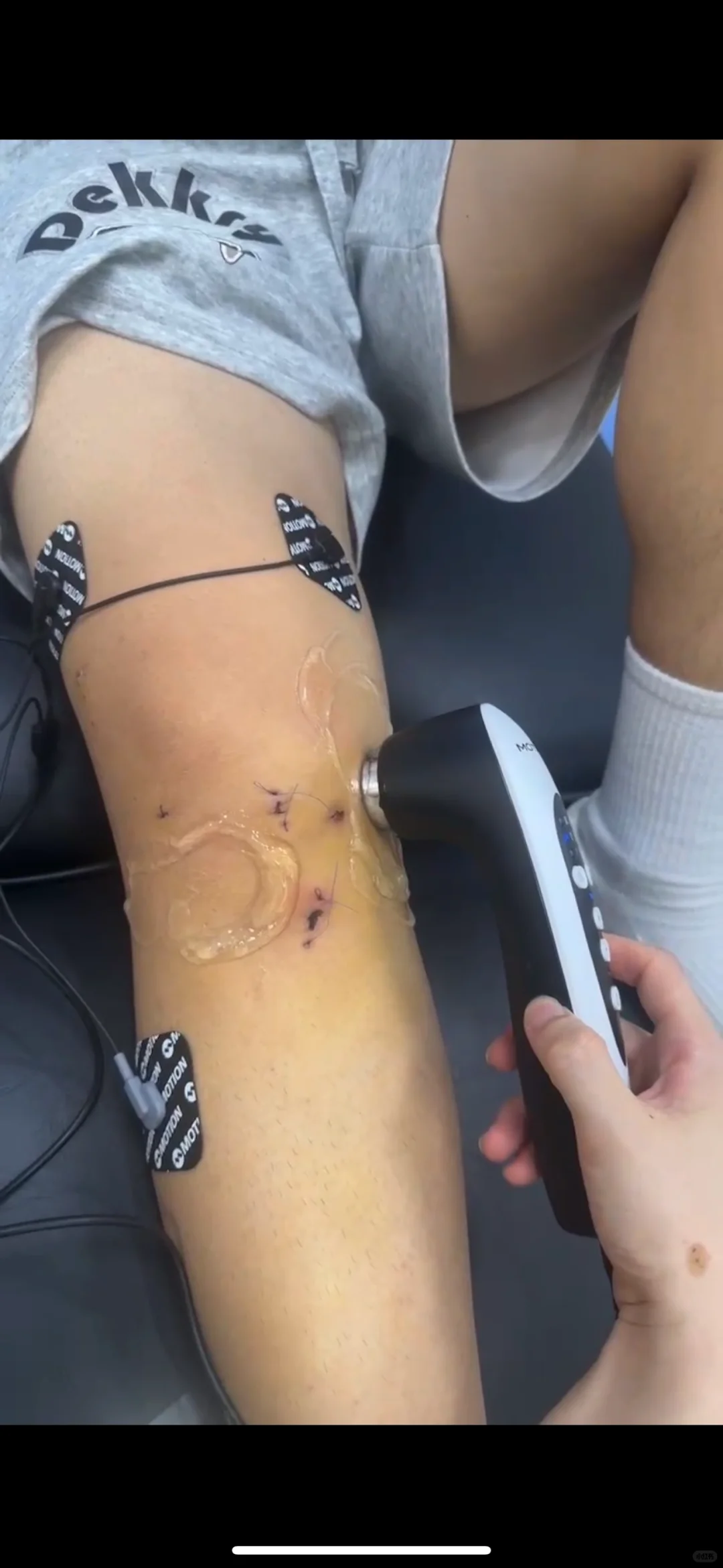 巨巨巨巨好用的便携式超声⭐️