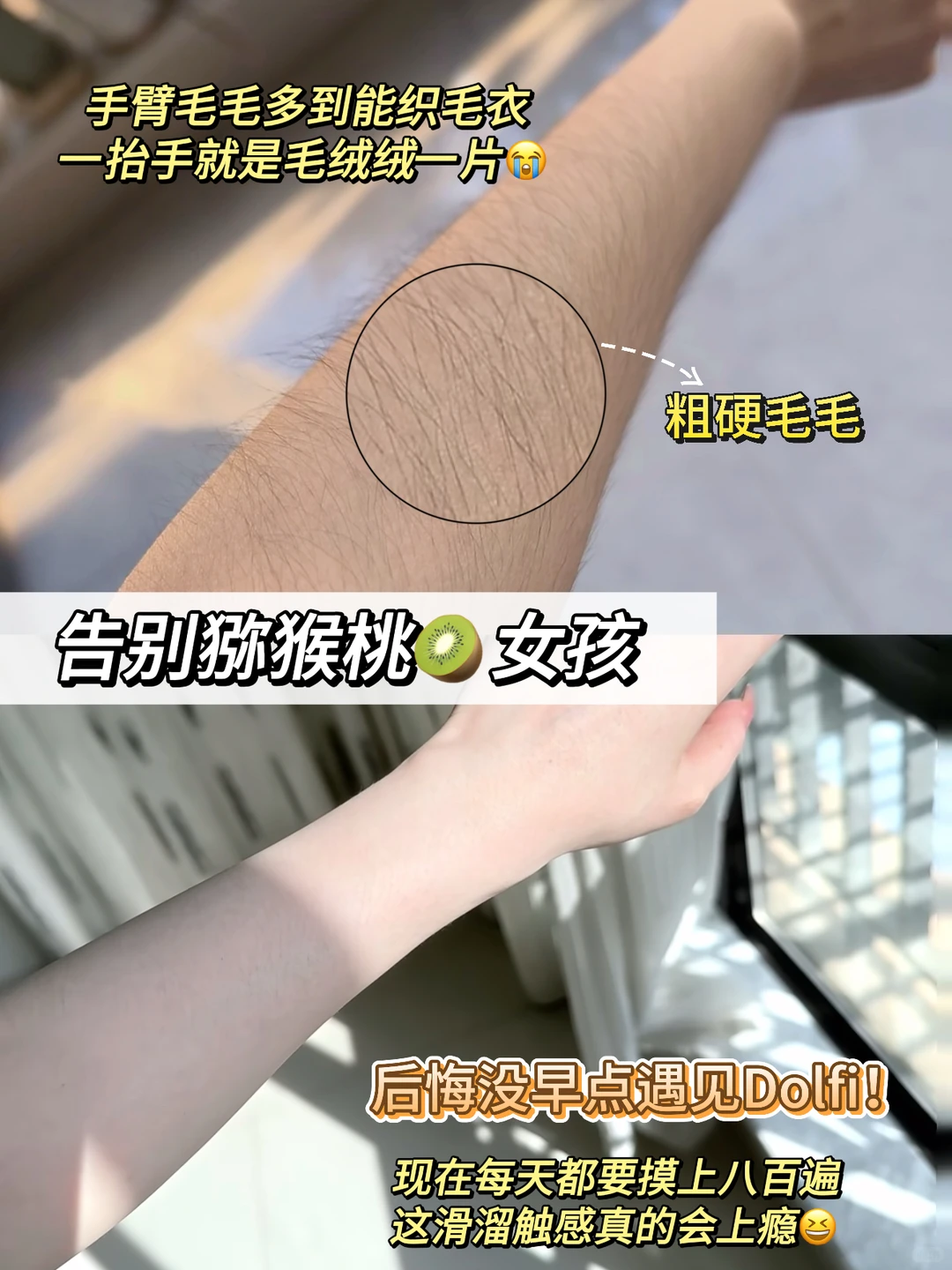 告别反复脱毛!SHR技术让我实现持续光滑肌