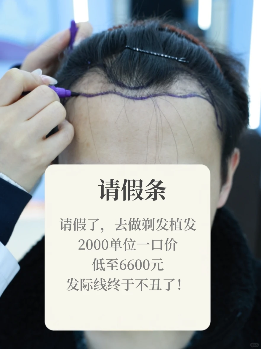 不用请假丨不剃发植发【案例版】低至6k！戳