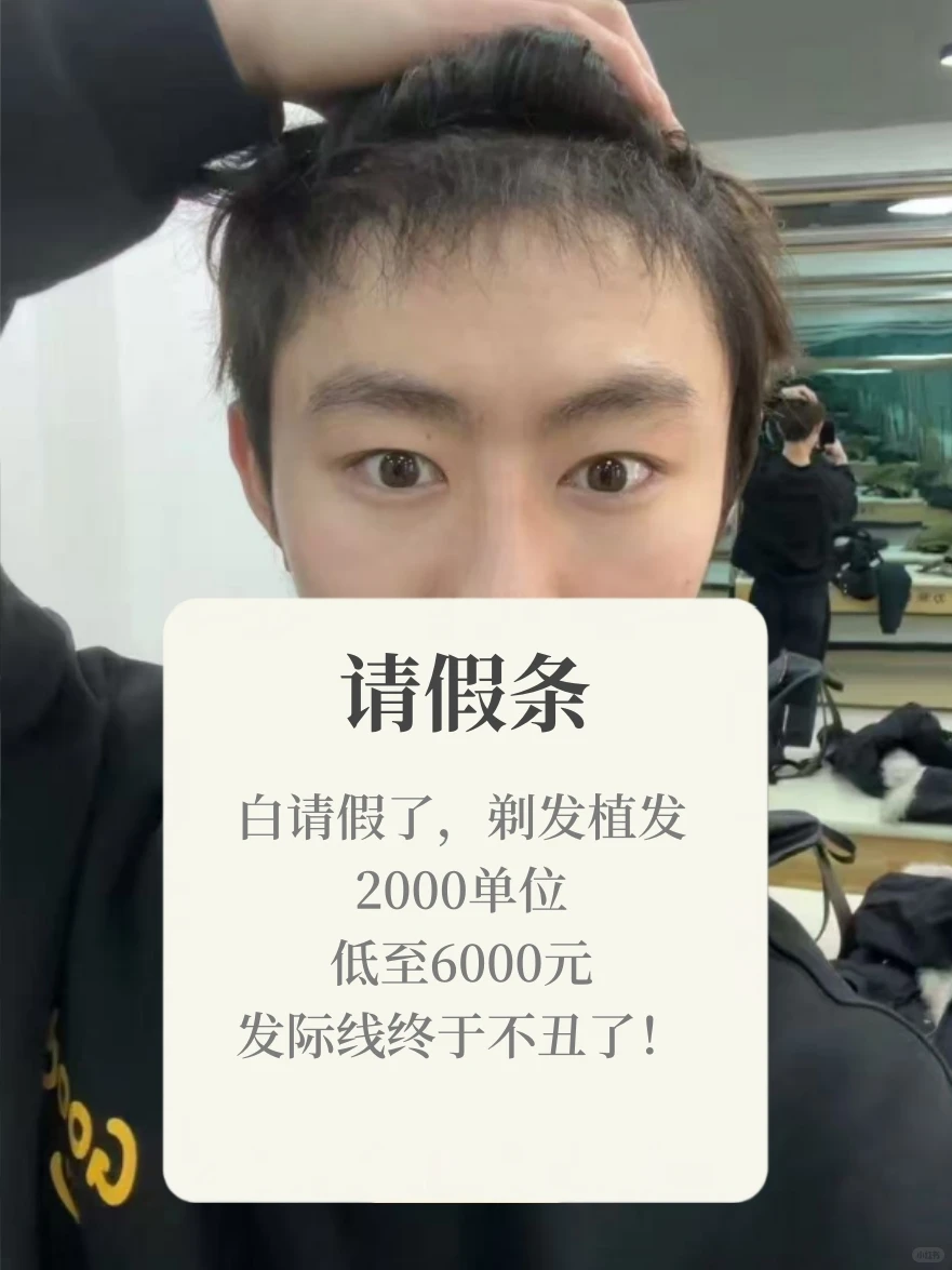 不用请假丨不剃发植发【案例版】低至6k！戳