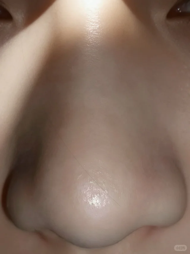 一个半月生理盐水（毛孔）