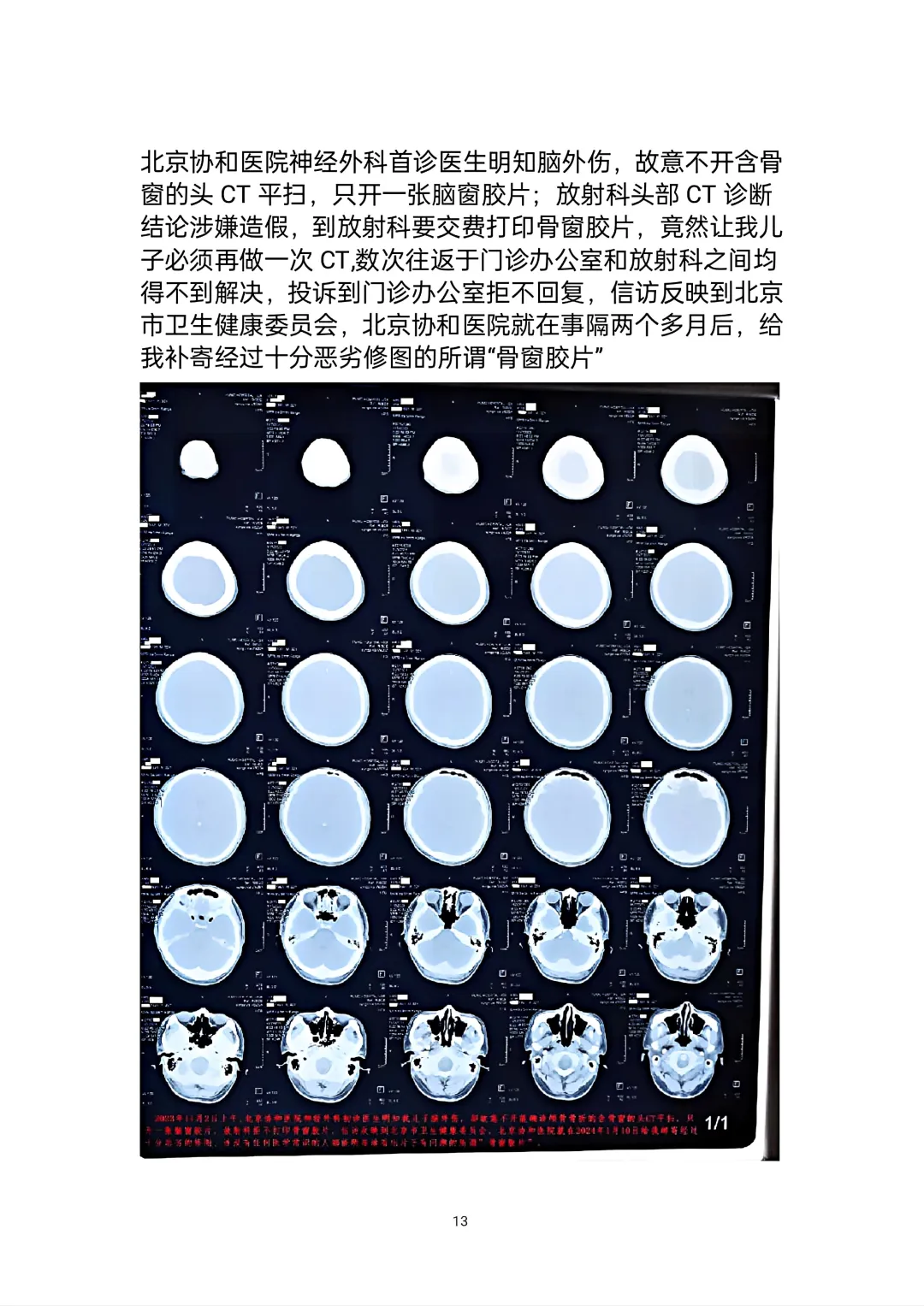 北京协和医院头部CT影像及诊断造假