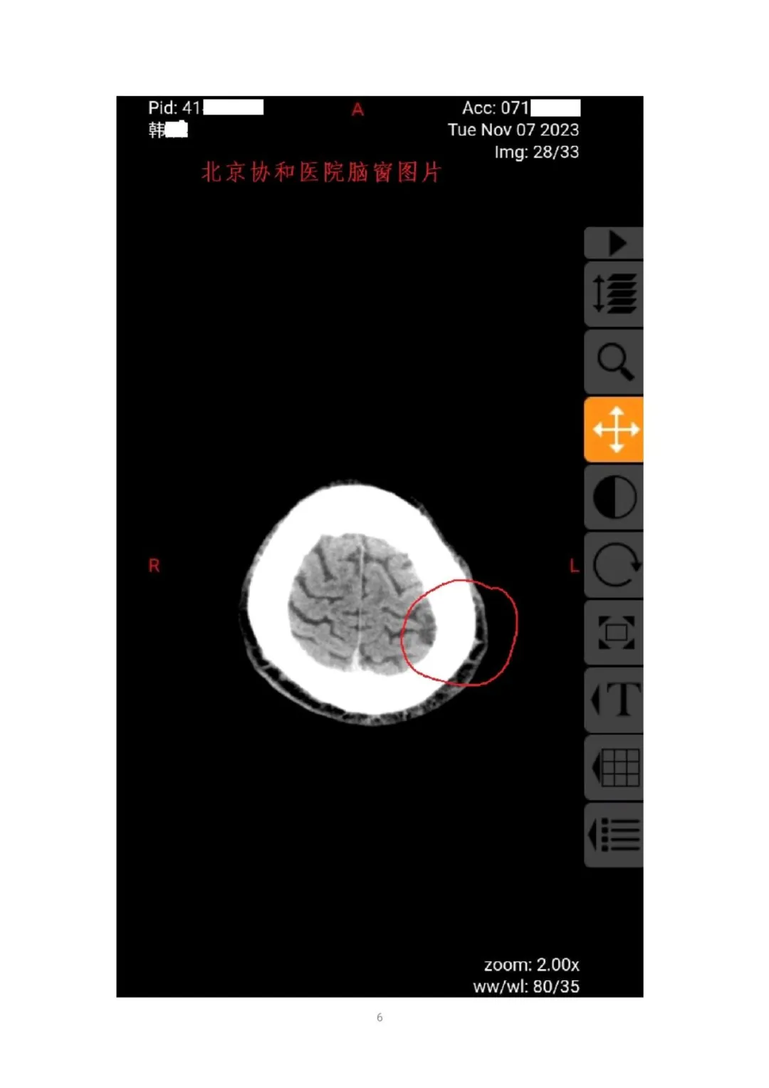 北京协和医院头部CT影像及诊断造假