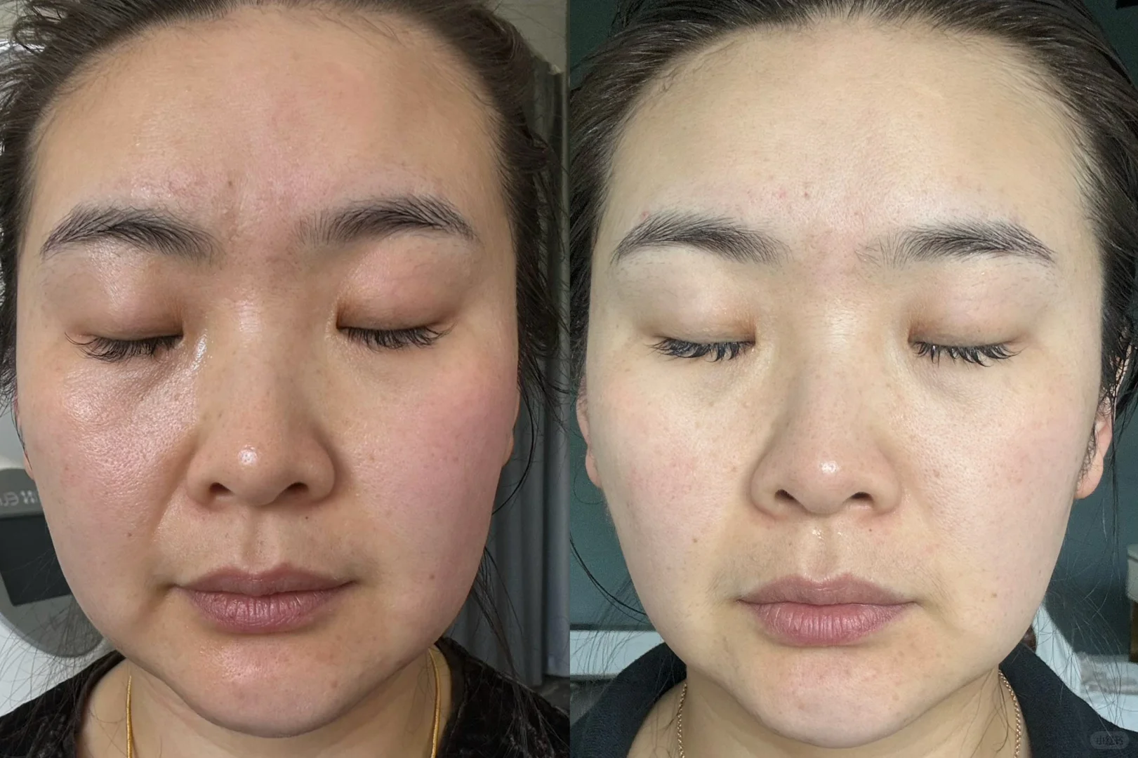 一个月的抗衰改变