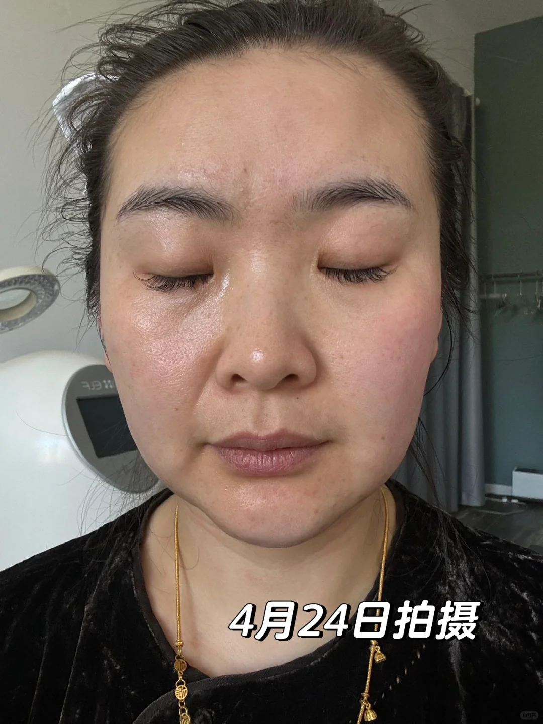 一个月的抗衰改变