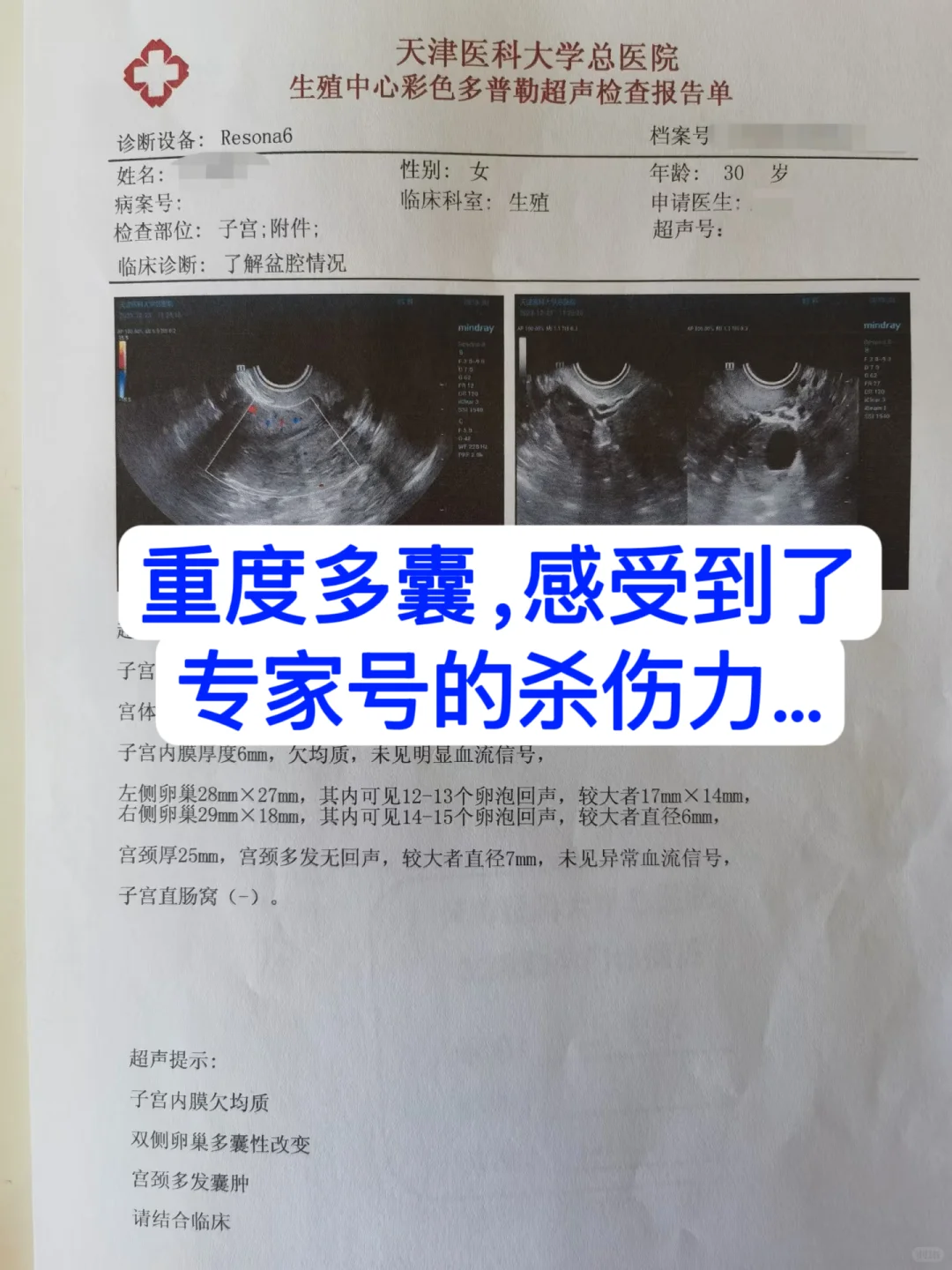 第一次感受到专家号对多囊的杀伤力