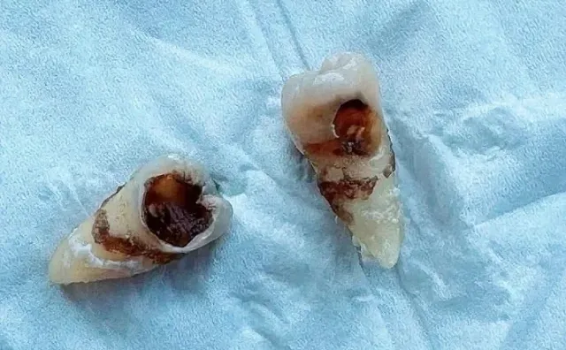 已离职，种牙能劝一个是一个吧……